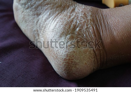 Close-up of skin peeling on the heel. This foot has just removed the cast.