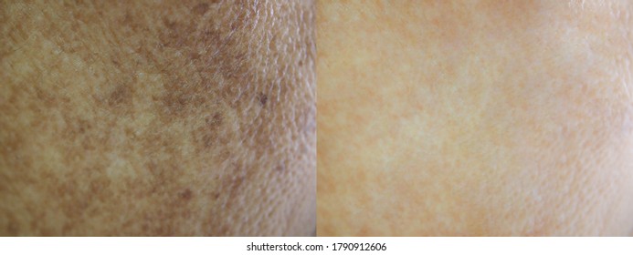 Closeup skin texture before and after spot melasma pigmentation facial treatment on face asian woman. Problem skincare and health concept. 