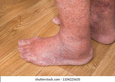 Close-up of skin with varicose veins on senior male leg. Concept of dry skin, old senior people, varicose veins and deep vein thrombosis or DVT