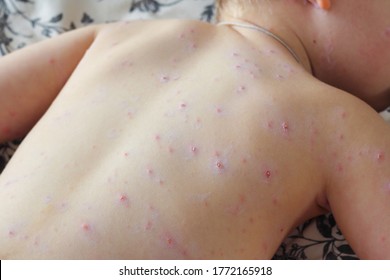 Close-up Of A Small Child With Chickenpox Virus Or Chickenpox Bubble In A Hurry. Calamine Zinc Lotion Covering Red Spots. Chicken Pox Rash, Viral Infections Or Chickenpox Disease