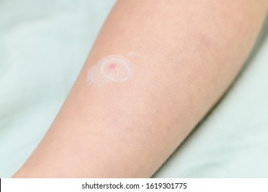 Close-up Of A Small Child's Leg With Chickenpox Virus Or Blistering Rash Covering Red Spots With Calamine Zinc Lotion. The Concept Of Quarantine In Kindergarten