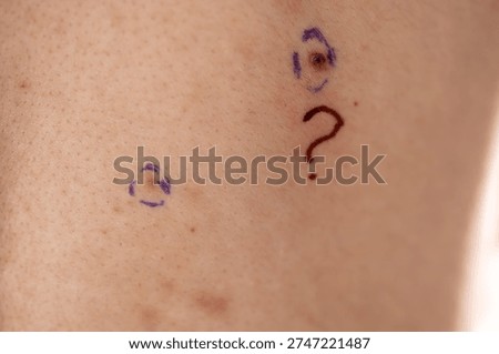 Closeup of a small mole on human skin, circled with marker and marked by a question mark, symbolizing suspicious lesion, dermatology examination and skin cancer screening.
