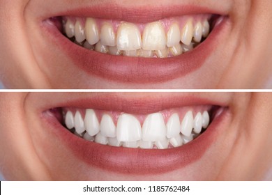 Close-up Of A Smiling Woman's Teeth Before And After Whitening