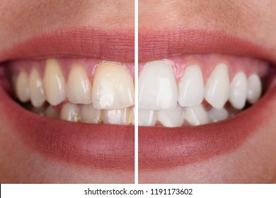 Close-up Of A Smiling Woman's Teeth Before And After Whitening - Shutterstock ID 1191173602