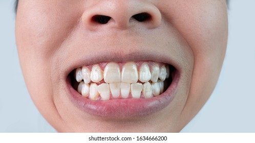 Close-up Of A Smiling Woman's Teeth Revealing White Spots And Plaque On The Tooth Surface. Oral Care And Dental Concept.