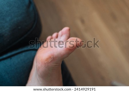Close-up of a soft callus on a foot of a woman, sport shoes problem, corn on the leg. blister on the feet 