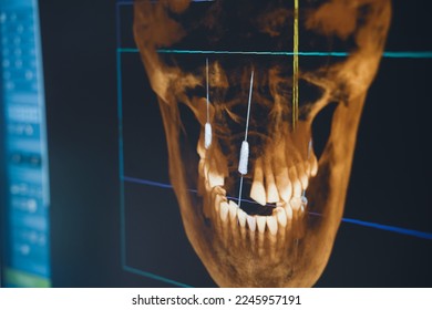 cierre de la interfaz de software de radiografía dental de rayos X en pantalla digital en clínica dental 