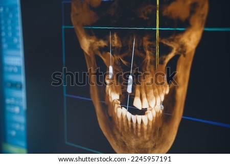 closeup of software interface of dental radiography x-ray on digital screen in dental clinic 