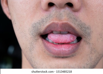 Close-up Sore Tongue, Aphthous Stomatitis ,lip Leison.