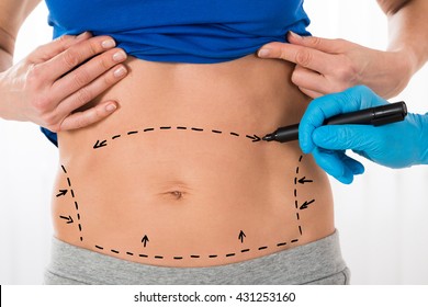 Close-up Of Surgeon Hands Drawing Correction Lines On Woman Stomach - Shutterstock ID 431253160