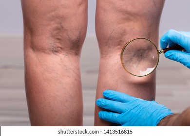 Close-up Of A Surgeon Wearing Blue Surgical Gloves Examining The Varicose Veins Through Magnifying Glass
