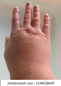 Closeup Of Swelling Hand With Bug Bites And Swollen Knuckles. White Female Hand And Fingers Swelling From Insect Bites.