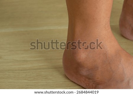 Close-up of swollen outer ankle with visible lump, highlighting possible ganglion cyst or inflammation. Ideal for medical, orthopedic, or wellness visuals.