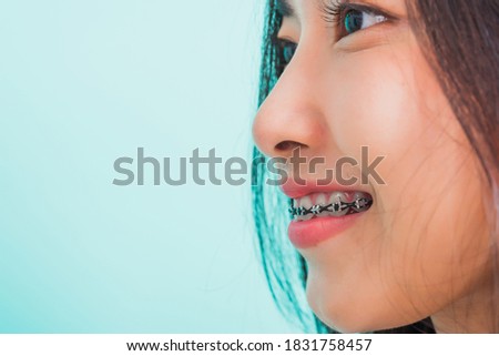 Closeup teen Asian beautiful young woman smile have dental braces on teeth laughing, studio shot isolated on a blue background, medicine and dentistry female mouth concept