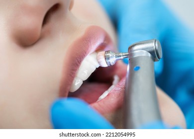 Close-up of teeth with brushing technology in the dentist's office. Dentistry and cleaning and whitening procedure. - Powered by Shutterstock