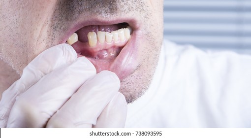 Closeup Teeth, Dental Health Care Clinic With Missing Tooth