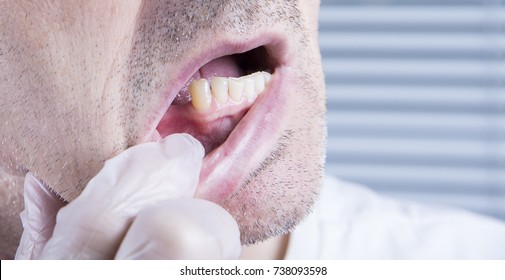 Closeup Teeth, Dental Health Care Clinic With Missing Tooth