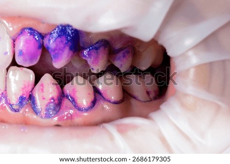 Close-up of teeth with disclosing solution showing plaque buildup