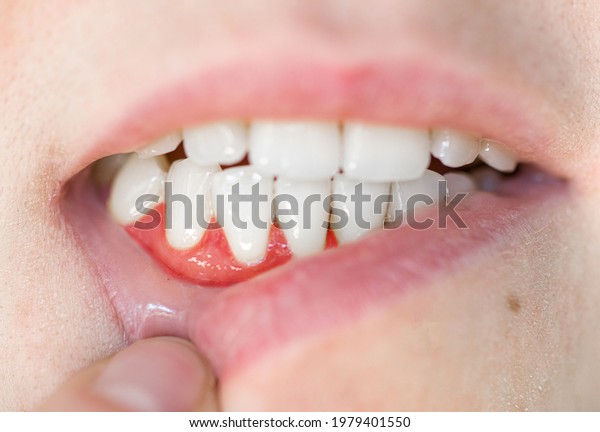 close-up of teeth. gum disease\
in a woman, periodontal disease. tartar removal, dental\
treatment