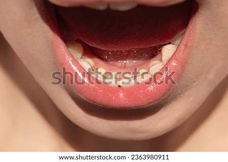 Closeup of teeth with a permanent bonded retainer.