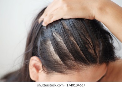 Closeup Thin Hair On Scalp Of Head Woman.