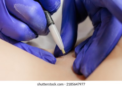 Close-up Of The Tip Of The Hair Electrolysis Device Where The Doctor Inserts The Needle Into The Hair Follicle