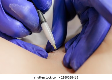 Close-up Of The Tip Of The Hair Electrolysis Device Where The Doctor Inserts The Needle Into The Hair Follicle