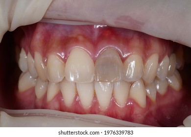 Closeup Tooth Discoloration At Left Upper Central Incisor Tooth