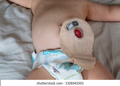 Close-up top view on transparent colostomy pouch attached to baby patient. Ostomy bag with filter. Colostomy surgery. Medical theme. 