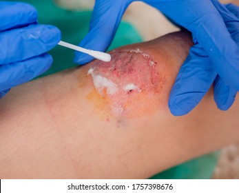 Close-up, Treatment Of An Abrasion On The Knee Of A Teenage Girl By A Doctor.