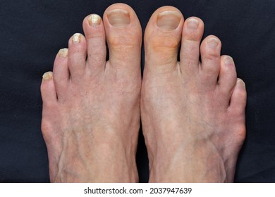 Closeup of two caucasian feet, one with mycosis, fungal nail infection, the other not infected, side by side comparison, reference point of fungus infected toe nails versus non infected toe nails, blu