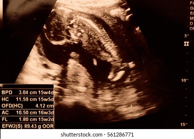 Closeup ultrasound portrait of the fetus,15 weeks.
