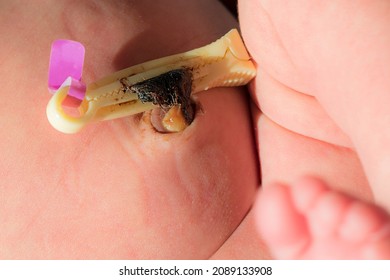 Close-up Of The Umbilical Cord Clamp With Its Tag On A Newborn