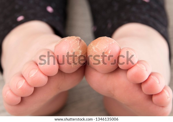 cracked skin under toes child