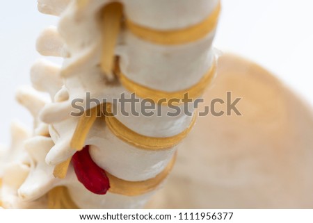 Close-up view of artificial human herniated lumbar intervertebral disc model