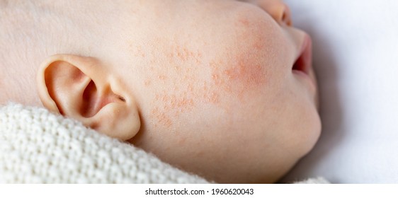 close-up view of baby cheek with allergy rash red pimples or atopic dermatitis