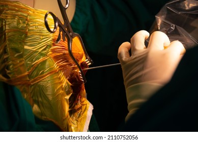 Close-up View Of Cannula Inserting Into Burr Hole For Brain Tumor Biopsy In Neurosurgical Operating Room.