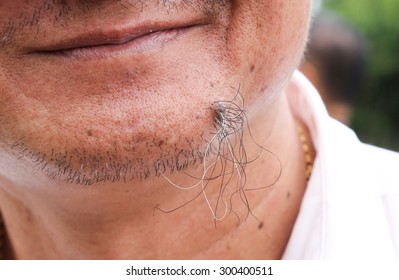 Ingrown Hair Images Stock Photos Vectors Shutterstock