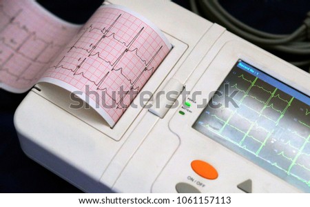 Closeup view of ECG machine display and print out trip chart indicating pulse tare and condition of a patient                                      