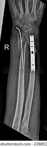 Close-up view of a hand X-ray, highlighting intricate Distal radius ulna fracture fixation. 