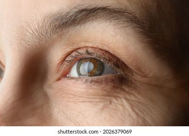Closeup view of mature woman with cataract