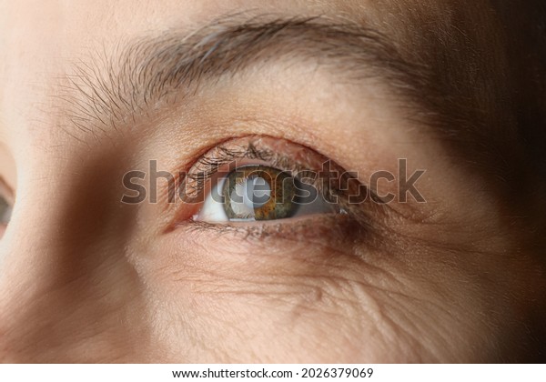 Closeup view of mature\
woman with cataract