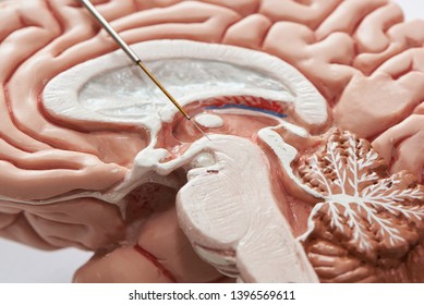 Close-up view of microelectrode recording on the brain model. Concept of brain recording in subthalamic nucleus for Parkinson disease surgery.