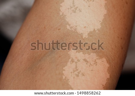 A closeup view on the arm of a person suffering from tinea versicolor, a fungal infection of malassezia globosa, causing patches of skin discoloration.