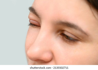 A Closeup View On The Eyes Of A Caucasian Girl, With One Eye Close, Painful, Red And Swollen From A Hordeolum (stye), Common Bacteria Infection Of The Eye.