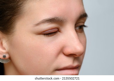 A Closeup View On The Eyes Of A Caucasian Girl, With One Eye Close, Painful, Red And Swollen From A Hordeolum (stye), Common Bacteria Infection Of The Eye.