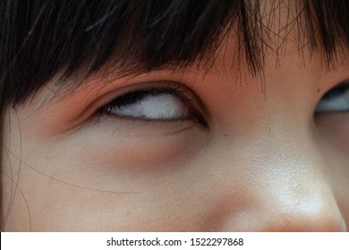 A closeup view on the eyes of a young child during a seizure, child suffering from epilepsy begins fitting as the pupils and iris roll up towards the ceiling.