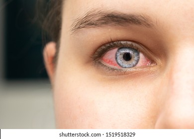 A closeup view on the face of a beautiful caucasian woman, sick and unwell with a red bloodshot eye, a common symptom of conjunctivitis, a bacterial infection of the eyeball.