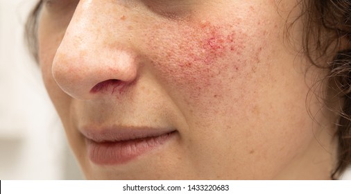 A Closeup View On The Face Of A Young Woman Suffering With Rosacea On Her Cheeks And Beneath Her Nose. Red Blotches And Prominent Blood Vessels Are Seen In Detail.