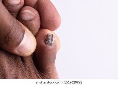 black pinky toe